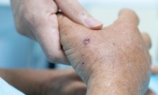 Chạm vào tổ ong vò vẽ, người đàn ông sốc phản vệ suýt mất mạng