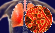 Những dấu hiệu cảnh báo sớm bệnh lao phổi bạn không nên bỏ qua