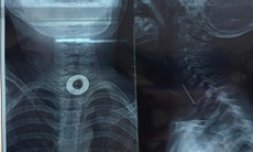 Nội soi gắp chiếc long đen mắc trong thực quản bé 7 tuổi