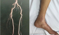 Thầy giáo suýt bị cưa 2 chân do tắc mạch chi từ lâu nhưng không có điều kiện đi chữa