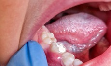 Kem đánh răng không chứa fluor có đủ bảo vệ răng bé?