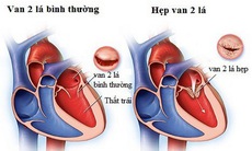 Khó thở cảnh giác với bệnh hẹp van hai lá