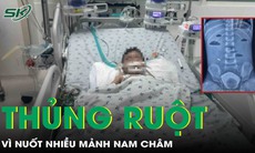 Bé trai 3 tuổi bị thủng ruột do nuốt nhiều mảnh nam châm