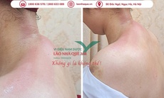 Đau vai gáy dai dẳng - cảnh báo thoái hóa đốt sống cổ từ thói quen xấu