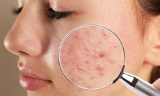 Bôi kem đánh răng có giúp điều trị mụn trứng cá?