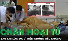 Chân hoại tử đen sì sau khi lóc da vì biến chứng tiểu đường 
