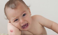 Cảnh giác với nhọt, áp xe, tổn thương da ở trẻ trong mùa hè