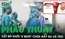 Khám sức khoẻ bàng hoàng phát hiện khối ‘u quái’ chứa đầy da và tóc