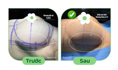 Điều trị ngực cứng sau nâng ngực