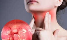 Viêm họng cấp có thể gây ra biến chứng gì?