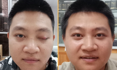 Phương pháp Đông y trong điều trị sụp mí mắt do liệt dây thần kinh số 3