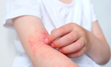 Bài thuốc điều trị viêm da cơ địa