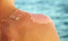Chữa viêm da do cháy nắng, bỏng nắng bằng Đông y