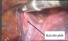 Đột ngột khó thở cảnh giác với kén khí phổi