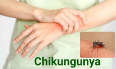 Bệnh Chikungunya: Nguyên nhân, triệu chứng, cách điều trị và phòng bệnh