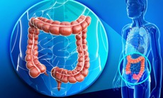 Phòng ngừa ung thư đại trực tràng