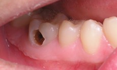 Nhận biết và đề phòng sâu răng ở trẻ