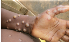 WHO khuyến cáo điều trị HIV sớm cho bệnh nhân đồng nhiễm Mpox