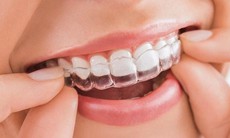 Loại mắc cài nào tốt nhất để niềng răng?