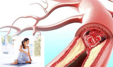 4 thay đổi lối sống hàng đầu giúp giảm nguy cơ tắc nghẽn động mạch
