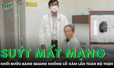 Trì hoãn điều trị, người đàn ông suýt mất mạng vì khối bướu bàng quang khổng lồ xâm lấn toàn bộ thận
