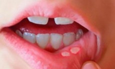 Lưu ý đặc biệt khi bị nhiệt miệng