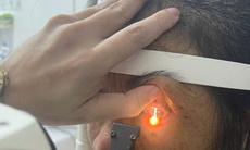 Bỏng mắt vì gội đầu bằng rượu ngâm hạt na