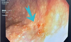 Phát hoảng vì đại tràng người phụ nữ 63 tuổi nhiều giun ký sinh