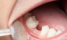 Mất răng số 7 hàm dưới có sao không? Giải pháp khắc phục hiệu quả