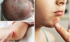 Viêm nang lông ở trẻ có nguy hiểm không?