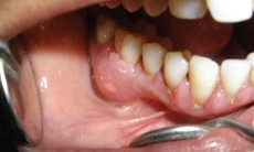 Áp-xe răng: 'Quả bom nổ chậm' nguy hiểm