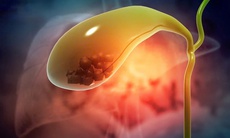 Viêm túi mật và các phương pháp kiểm soát hiệu quả