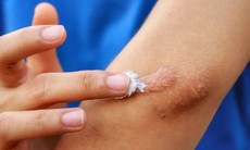 Bộ Y tế đình chỉ, thu hồi toàn quốc, yêu cầu tiêu huỷ 1 loại gel 'ngừa sẹo' do vi phạm 3 lỗi
