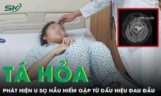 Cô gái 19 tuổi tá hoả phát hiện u sọ hầu hiếm gặp từ dấu hiệu mờ mắt, đau đầu
