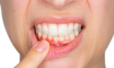 5 sai lầm 'tai hại' khi đánh răng, 'hủy hoại' nướu (lợi) mỗi ngày