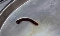 Phát hoảng đỉa rừng dài 4cm chui sâu trong hốc mũi bé gái 9 tuổi