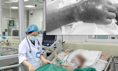 Bị tai nạn lao động nhưng không tiêm phòng uốn ván, bệnh nhân rơi vào nguy kịch