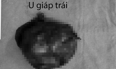 Suýt mất mạng vì chủ quan với bướu giáp lành tính