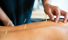 Nghiên cứu Mỹ khẳng định châm cứu hiệu quả với chứng đau lưng mạn tính