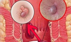 Cách phân biệt bệnh trĩ và những bệnh hậu môn để tránh nhầm lẫn