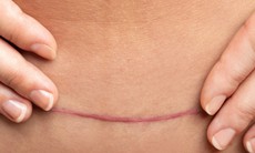 Để vết mổ sau sinh mau lành và không để lại sẹo