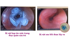 Cứu thành công bé 5 tuổi bị kẹt kẹp tóc trong thực quản