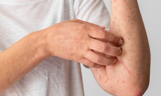 Các biện pháp phòng ngừa viêm da cơ địa