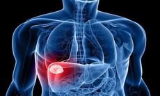 Áp xe gan có biểu hiện gì?