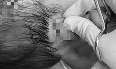 Bé gái 19 tháng tuổi bị chó dữ tấn công