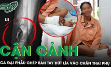 Lý do bác sĩ phải nối tạm bàn tay đứt lìa vào chân thai phụ song thai 