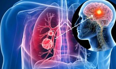 5 bí quyết phòng ngừa ung thư phổi cần biết