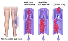 Các yếu tố nguy cơ gây bệnh huyết khối tĩnh mạch sâu