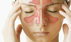 Viêm xoang mũi dị ứng do đâu, làm sao để tránh?