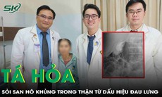 Đau lưng âm ỉ, cụ bà 71 tuổi tá hỏa vì sỏi san hô khủng trong thận